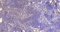 Immunohistochemical analysis of paraffin-embedded human cervical carcinoma. 1, Antibody was diluted at 1:200 (4° STJ194824