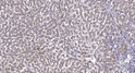 Immunohistochemical analysis of paraffin-embedded human liver cancer. 1, Antibody was diluted at 1:200 (4°C overnight). STJ194834