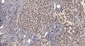 Immunohistochemical analysis of paraffin-embedded human liver cancer. 1, Antibody was diluted at 1:200 (4°C overnight). STJ194890