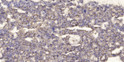 Immunohistochemical analysis of paraffin-embedded human liver cancer. 1, Antibody was diluted at 1:200 (4° overnight). STJ194907