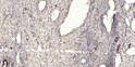 Immunohistochemical analysis of paraffin-embedded human oophoroma. 1, Antibody was diluted at 1:200 (4°C overnight). 2, STJ194919