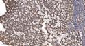 Immunohistochemical analysis of paraffin-embedded human liver cancer. 1, Antibody was diluted at 1:200 (4° overnight). STJ194939