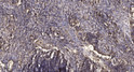 Immunohistochemical analysis of paraffin-embedded human squamous cell carcinoma of lung. 1, Antibody was diluted at STJ194942