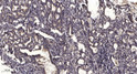 Immunohistochemical analysis of paraffin-embedded human gastric adenocarcinoma. 1, Antibody was diluted at 1:200 (4°C STJ194962