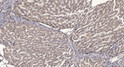 Immunohistochemical analysis of paraffin-embedded human liver cancer. 1, Antibody was diluted at 1:200 (4°C overnight). STJ194975