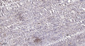 Immunohistochemical analysis of paraffin-embedded human colon cancer. 1, Antibody was diluted at 1:200 (4° overnight). STJ194994