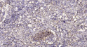 Immunohistochemical analysis of paraffin-embedded human lung cancer. 1, Antibody was diluted at 1:200 (4° overnight). STJ194996