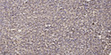 Immunohistochemical analysis of paraffin-embedded human liver cancer. 1, Antibody was diluted at 1:200 (4° overnight). STJ195016