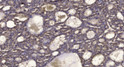 Immunohistochemical analysis of paraffin-embedded human liver cancer. 1, Antibody was diluted at 1:200 (4°C overnight). STJ195047