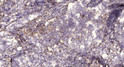 Immunohistochemical analysis of paraffin-embedded human lung cancer. 1, Antibody was diluted at 1:200 (4°C overnight). STJ195067