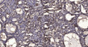 Immunohistochemical analysis of paraffin-embedded human liver cancer. 1, Antibody was diluted at 1:200 (4° overnight). STJ195068