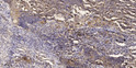 Immunohistochemical analysis of paraffin-embedded human squamous cell carcinoma of lung. 1, Antibody was diluted at STJ195090