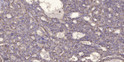 Immunohistochemical analysis of paraffin-embedded human liver cancer. 1, Antibody was diluted at 1:200 (4° overnight). STJ195105
