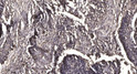 Immunohistochemical analysis of paraffin-embedded human squamous cell carcinoma of lung. 1, Antibody was diluted at STJ195106