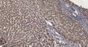 Immunohistochemical analysis of paraffin-embedded human liver cancer. 1, Antibody was diluted at 1:200 (4° overnight). STJ195113