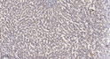 Immunohistochemical analysis of paraffin-embedded human liver cancer. 1, Antibody was diluted at 1:200 (4° overnight). STJ195134