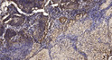 Immunohistochemical analysis of paraffin-embedded human squamous cell carcinoma of lung. 1, Antibody was diluted at STJ195149