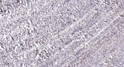Immunohistochemical analysis of paraffin-embedded human colon cancer. 1, Antibody was diluted at 1:200 (4° overnight). STJ195151