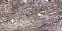 Immunohistochemical analysis of paraffin-embedded human squamous cell carcinoma of lung. 1, Antibody was diluted at STJ195172