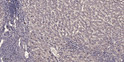 Immunohistochemical analysis of paraffin-embedded human liver cancer. 1, Antibody was diluted at 1:200 (4°C overnight). STJ195186