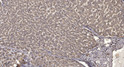 Immunohistochemical analysis of paraffin-embedded human liver cancer. 1, Antibody was diluted at 1:200 (4°C overnight). STJ195196
