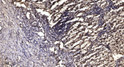Immunohistochemical analysis of paraffin-embedded human squamous cell carcinoma of the lung. 1, Antibody was diluted at STJ195197