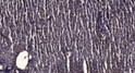 Immunohistochemical analysis of paraffin-embedded human liver cancer. 1, Antibody was diluted at 1:200 (4° overnight). STJ195220