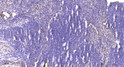 Immunohistochemical analysis of paraffin-embedded human cervical carcinoma. 1, Antibody was diluted at 1:200 (4° STJ195262