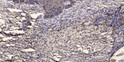 Immunohistochemical analysis of paraffin-embedded human squamous cell carcinoma of the lung. 1, Antibody was diluted at STJ195265