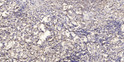 Immunohistochemical analysis of paraffin-embedded human squamous cell carcinoma of lung. 1, Antibody was diluted at STJ195268