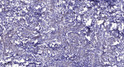 Immunohistochemical analysis of paraffin-embedded human breast cancer. 1, Antibody was diluted at 1:200 (4° overnight). STJ195278