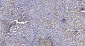 Immunohistochemical analysis of paraffin-embedded human liver cancer. 1, Antibody was diluted at 1:200 (4° overnight). STJ195286