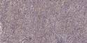 Immunohistochemical analysis of paraffin-embedded human colon cancer. 1, Antibody was diluted at 1:200 (4° overnight). STJ195303