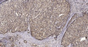 Immunohistochemical analysis of paraffin-embedded human liver cancer. 1, Antibody was diluted at 1:200 (4° overnight). STJ195401