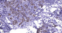 Immunohistochemical analysis of paraffin-embedded human breast cancer. 1, Antibody was diluted at 1:200 (4° overnight). STJ195408