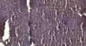Immunohistochemical analysis of paraffin-embedded human liver cancer. 1, Antibody was diluted at 1:200 (4° overnight). STJ195409