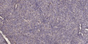 Immunohistochemical analysis of paraffin-embedded human colon cancer. 1, Antibody was diluted at 1:200 (4°C overnight). STJ195428