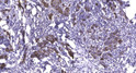 Immunohistochemical analysis of paraffin-embedded human breast cancer. 1, Antibody was diluted at 1:200 (4° overnight). STJ195430