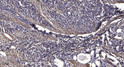 Immunohistochemical analysis of paraffin-embedded human gastric adenocarcinoma. 1, Antibody was diluted at 1:200 (4° STJ195435