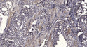 Immunohistochemical analysis of paraffin-embedded human gastric adenocarcinoma. 1, Antibody was diluted at 1:200 (4° STJ195447