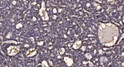 Immunohistochemical analysis of paraffin-embedded human liver cancer. 1, Antibody was diluted at 1:200 (4°C overnight). STJ195465