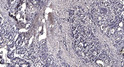 Immunohistochemical analysis of paraffin-embedded human gastric adenocarcinoma. 1, Antibody was diluted at 1:200 (4° STJ195480