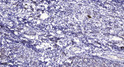 Immunohistochemical analysis of paraffin-embedded human breast cancer. 1, Antibody was diluted at 1:200 (4°C STJ195501
