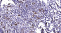 Immunohistochemical analysis of paraffin-embedded human breast cancer. 1, Antibody was diluted at 1:200 (4° overnight). STJ195513