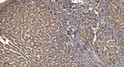 Immunohistochemical analysis of paraffin-embedded human liver cancer. 1, Antibody was diluted at 1:200 (4° overnight). STJ195516