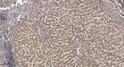 Immunohistochemical analysis of paraffin-embedded human liver cancer. 1, Antibody was diluted at 1:200 (4° overnight). STJ195523