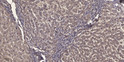 Immunohistochemical analysis of paraffin-embedded human liver cancer. 1, Antibody was diluted at 1:200 (4° overnight). STJ195539