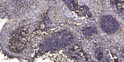Immunohistochemical analysis of paraffin-embedded human squamous cell carcinoma of lung. 1, Antibody was diluted at STJ195546