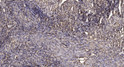 Immunohistochemical analysis of paraffin-embedded human squamous cell carcinoma of lung. 1, Antibody was diluted at STJ195564