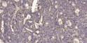 Immunohistochemical analysis of paraffin-embedded human liver cancer. 1, Antibody was diluted at 1:200 (4° overnight). STJ195610